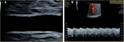 The abnormal umbilical venous–arterial index in the second half of pregnancy is associated with fetal outcome: A retrospective cross-sectional study